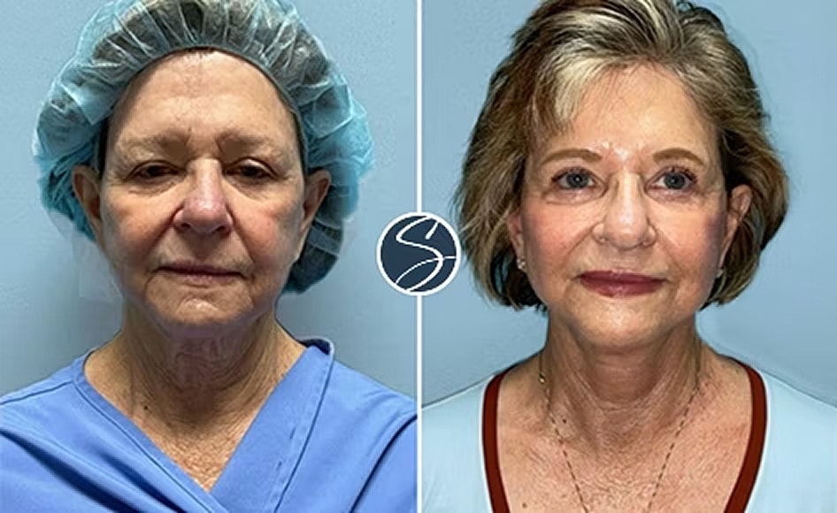 Before and after cosmetic procedure transformation.