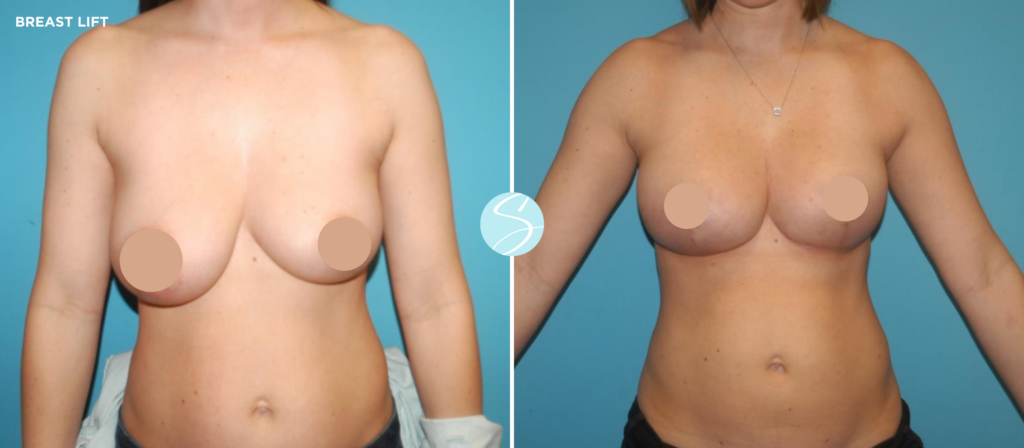 Stephens Plastic Surgery in Baton Rouge Breast Lift Before and After